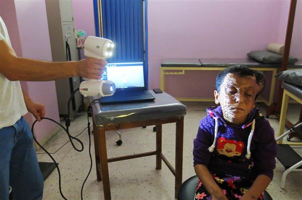 約旦安曼無國界醫生中東沖突受害者提供3D打印假肢