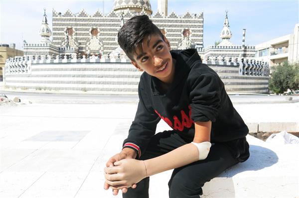 約旦安曼無國界醫生中東沖突受害者提供3D打印假肢